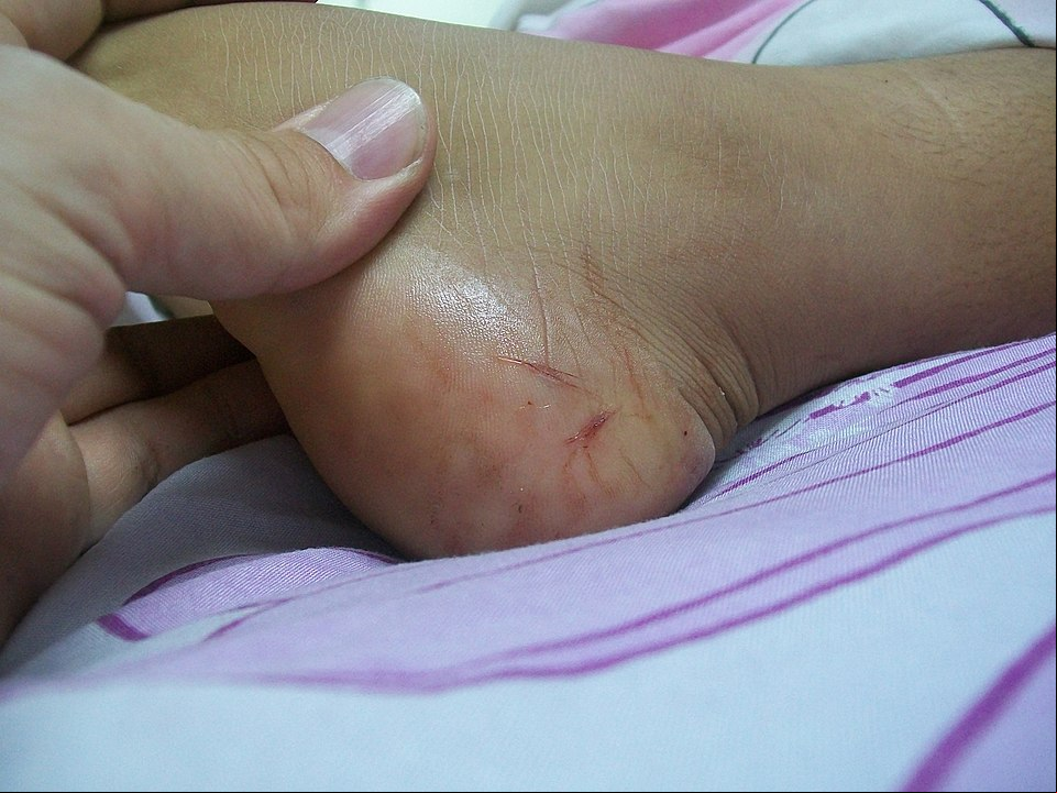 Em caso de mordida de cobra, não use torniquete, pois há risco de necrose e até amputação. Não se deve cortar o local, fazer perfurações ou sucção; o local da picada deve ser lavado com água e sabão; a vítima deve ser levada o mais rápido possível ao hospital.