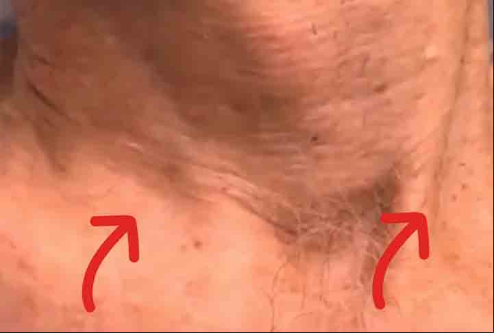 Para um diagnóstico preciso, é feita uma avaliação clínica, exame físico e eletrocardiograma. Por outro lado, em determinados casos, é preciso do teste ergométrico, o Holter, que registra o batimento cardíaco do paciente em suas atividades durante o dia.